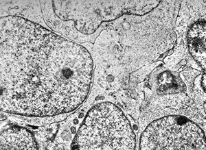 M,7y. | medulloblastoma